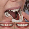 Kosmetische Zahnmedizin Prothese Zahnersatz für Falsche Zähne Lücken verbergen